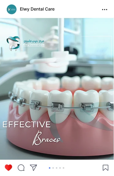 Elwy Dental Care post: a dental model with braces, Effective Braces