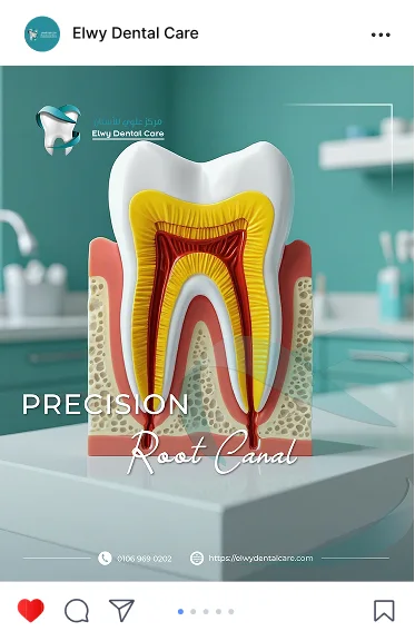 Elwy Dental Care post: a cross-section model of a tooth, Precision Root Canal