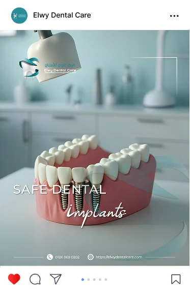 Elwy Dental Care post: a dental implant model, Safe Dental Implants